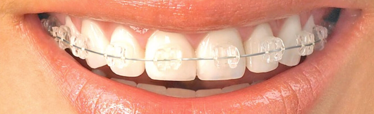 Brackets estéticos transparentes